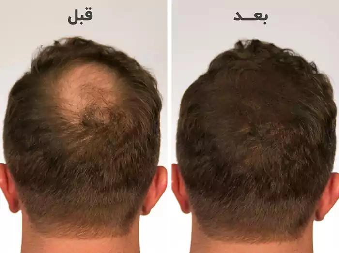 قبل و بعد از استفاده از هیر فیلر، بهبود قابل توجه حجم و کیفیت موها