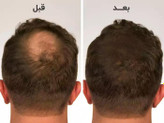 قبل و بعد از استفاده از هیر فیلر، بهبود قابل توجه حجم و کیفیت موها