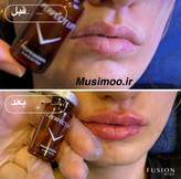 تصویر کوکتل F-PERFECT LIPS فیوژن اصل برای حجمدهی و فرمدهی طبیعی لبها