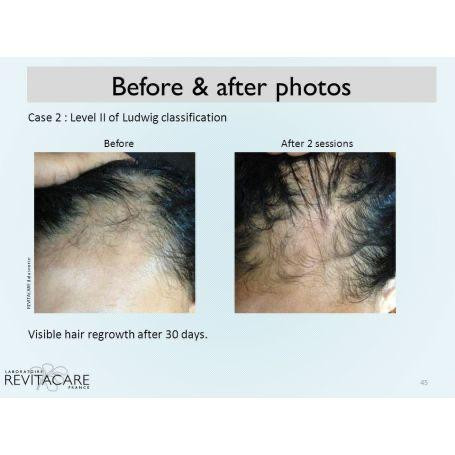 عکس قبل و بعد از استفاده از رویتاکر هیرکر مو