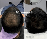 عکس محصول مزوتراپی فیوژن اصلی مخصوص آقایان جهت تقویت فولیکول و رشد مجدد مو