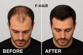 کوکتل مزوتراپی فیوژن F-Hair ۱۰ میلیلیتر — اورجینال با کیوآرکد و دو لیبله