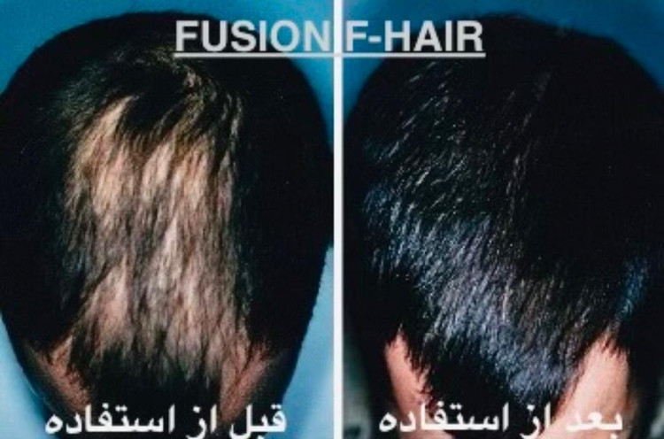 عکس قبل و بعد از استفاده فیوژن اف هیر.gpj