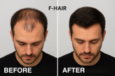 fusion-fhair-doublelabel.jpg → مزوتراپی-اف-هیر-دولیبل.jpg