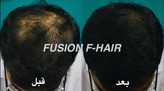 fusion-fhair-hairgrowth.jpg → تقویت-رشد-مو-با-اف-هیر.jpg